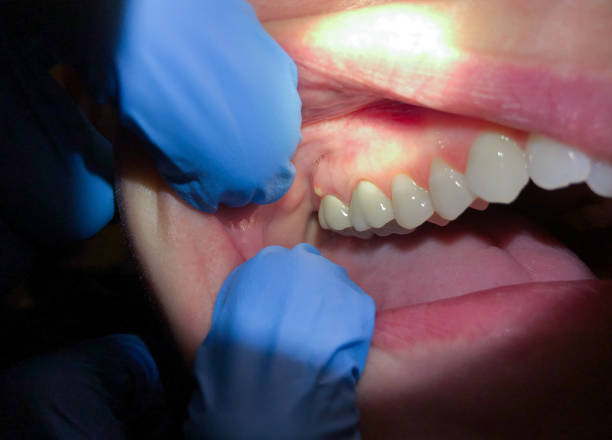 Best Dental Abscess Treatment in Colonial Heights, VA
